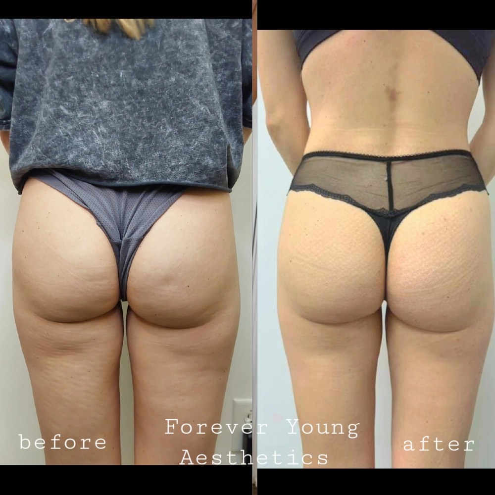 before & after 36