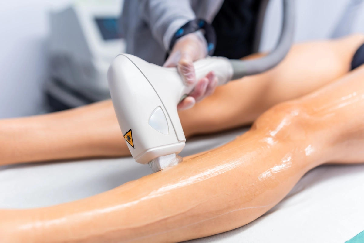 laser treatment