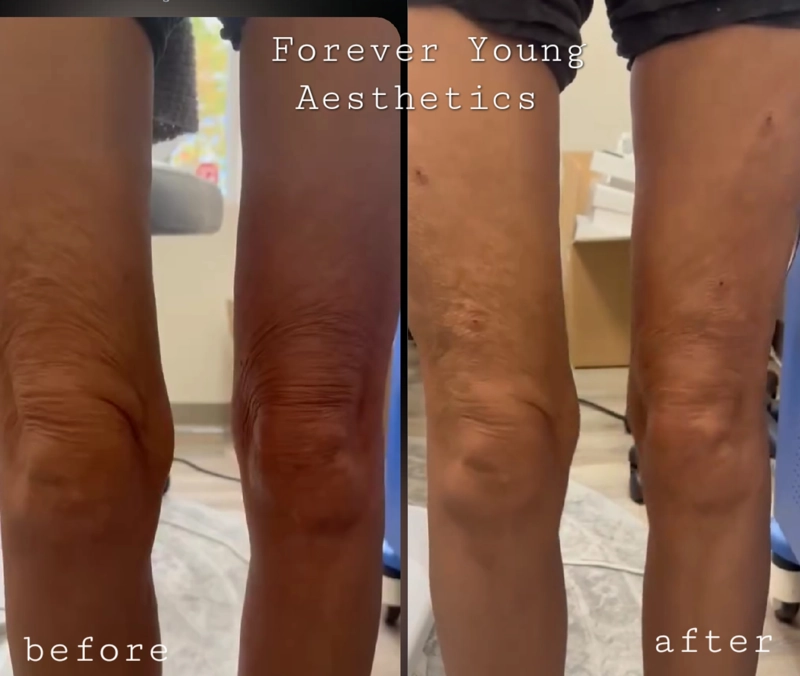 before & after 35