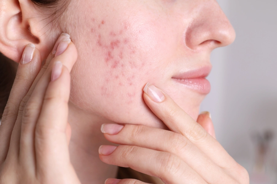 face acne