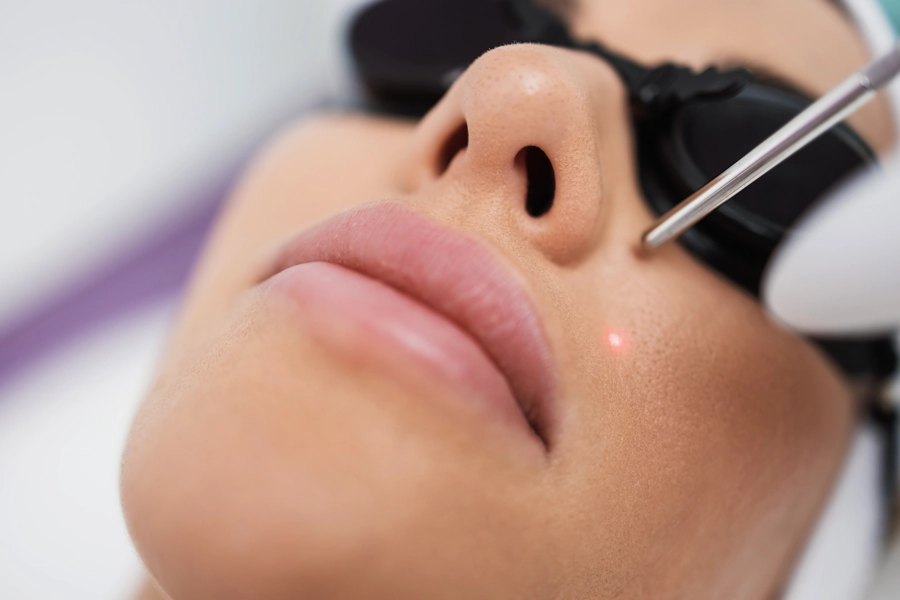 Face Laser