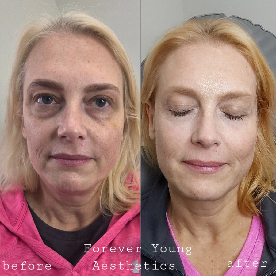 before & After 32