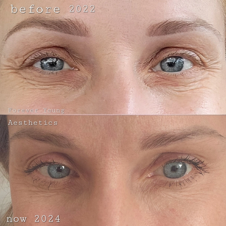 before & After 30