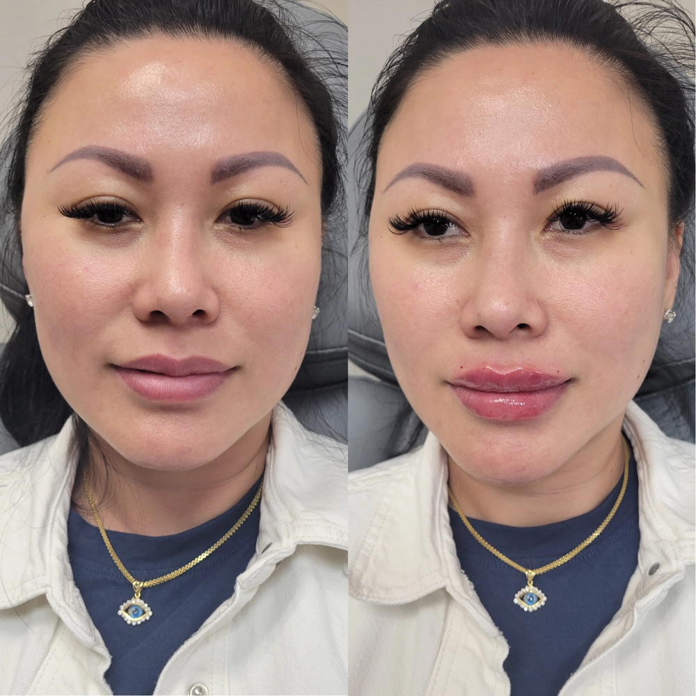 Lips filler