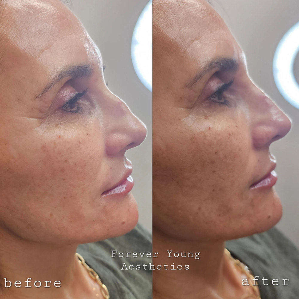 before & before 44