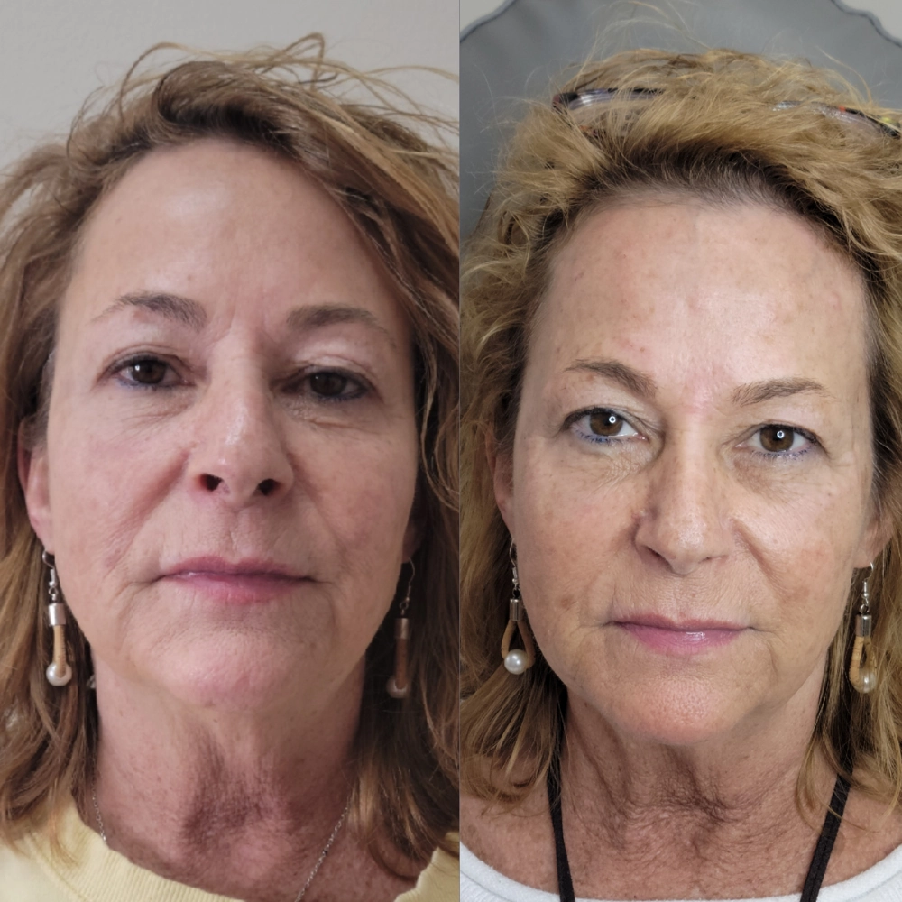 before & after 38
