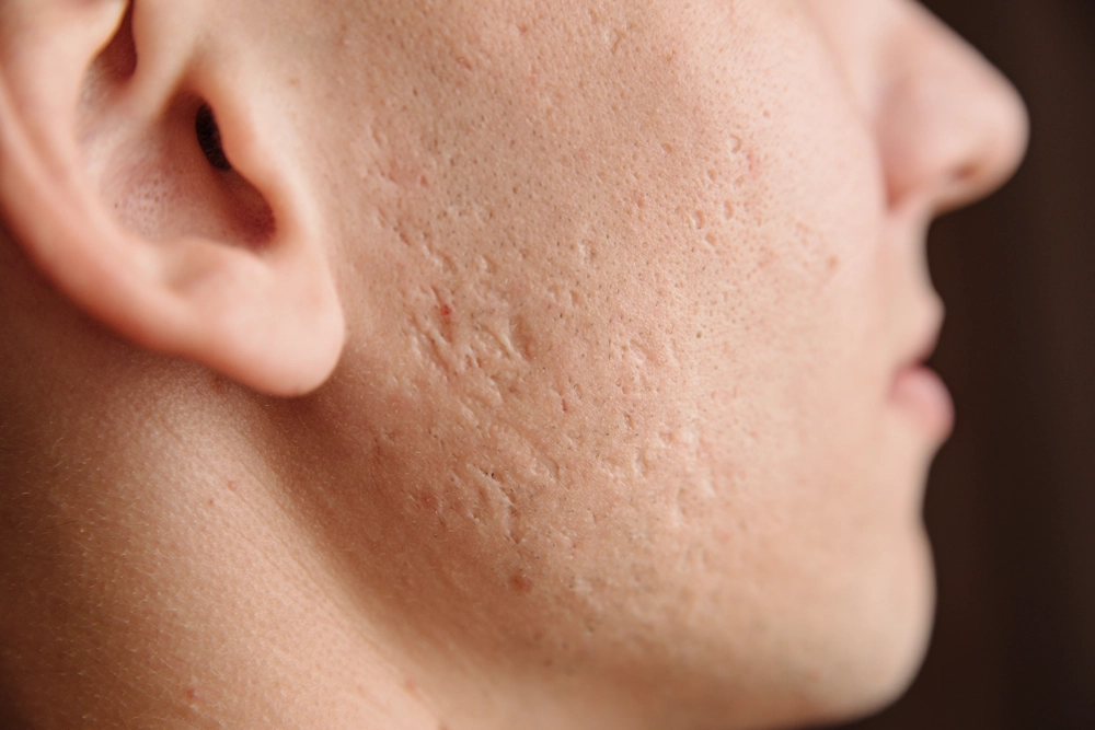 face acne