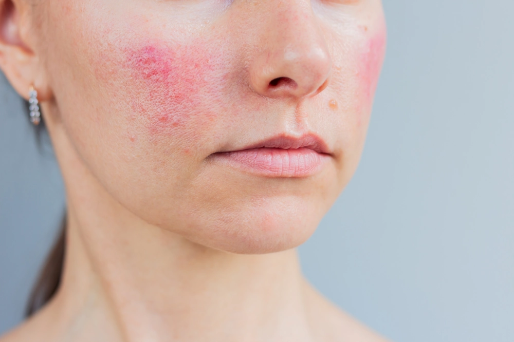 skin redness