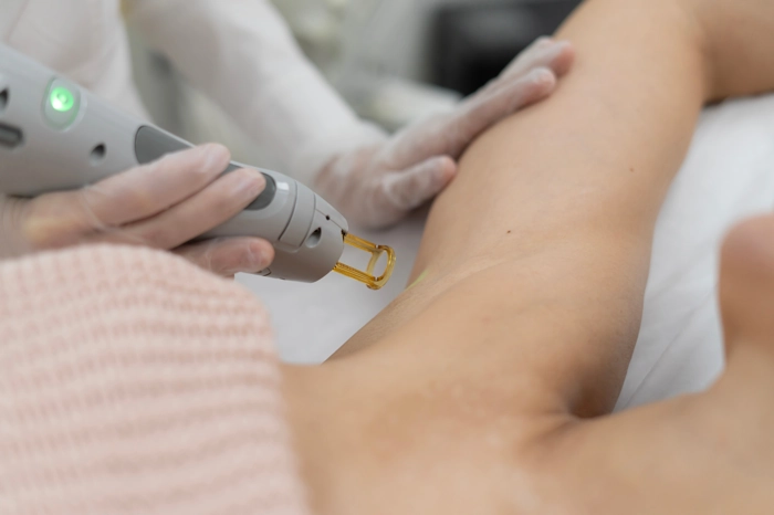 Laser Hair Removal