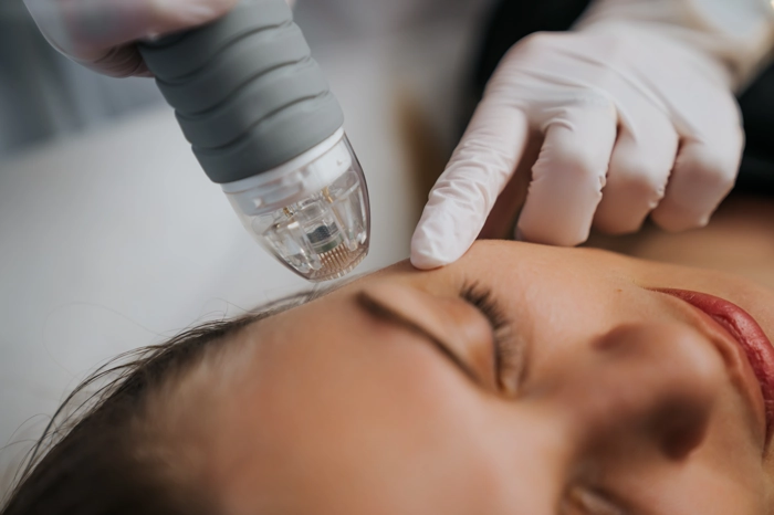 face laser treatment
