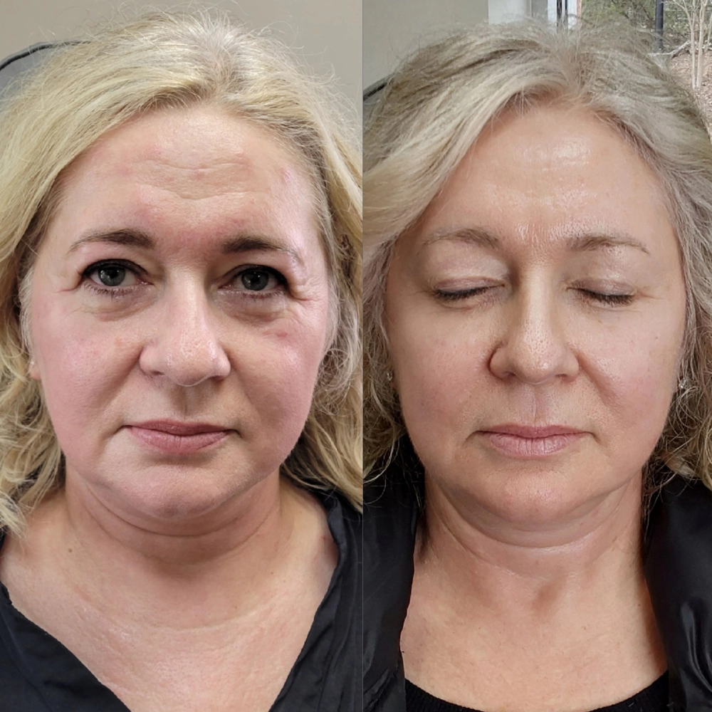 before & after 39