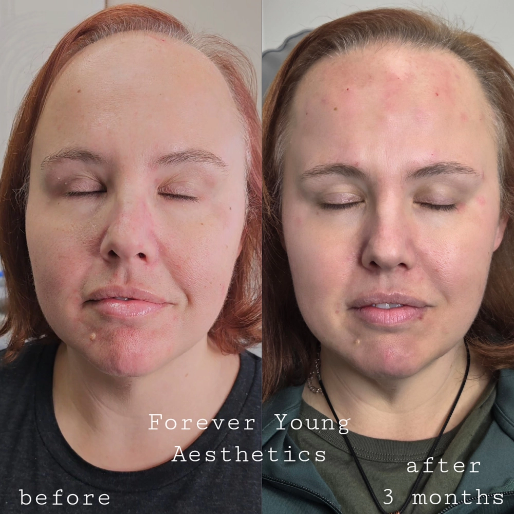 before & after 40