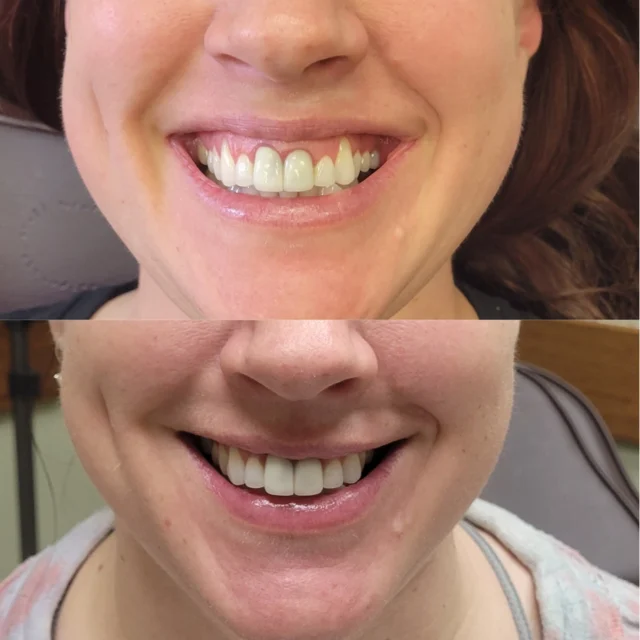 before & after 23