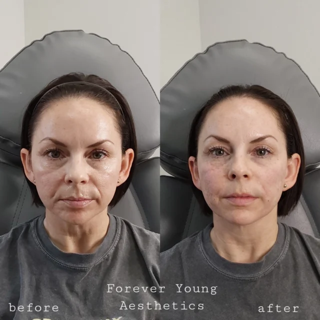 before & after 22