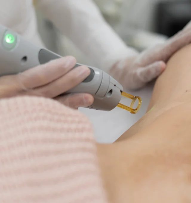 Laser Treatment