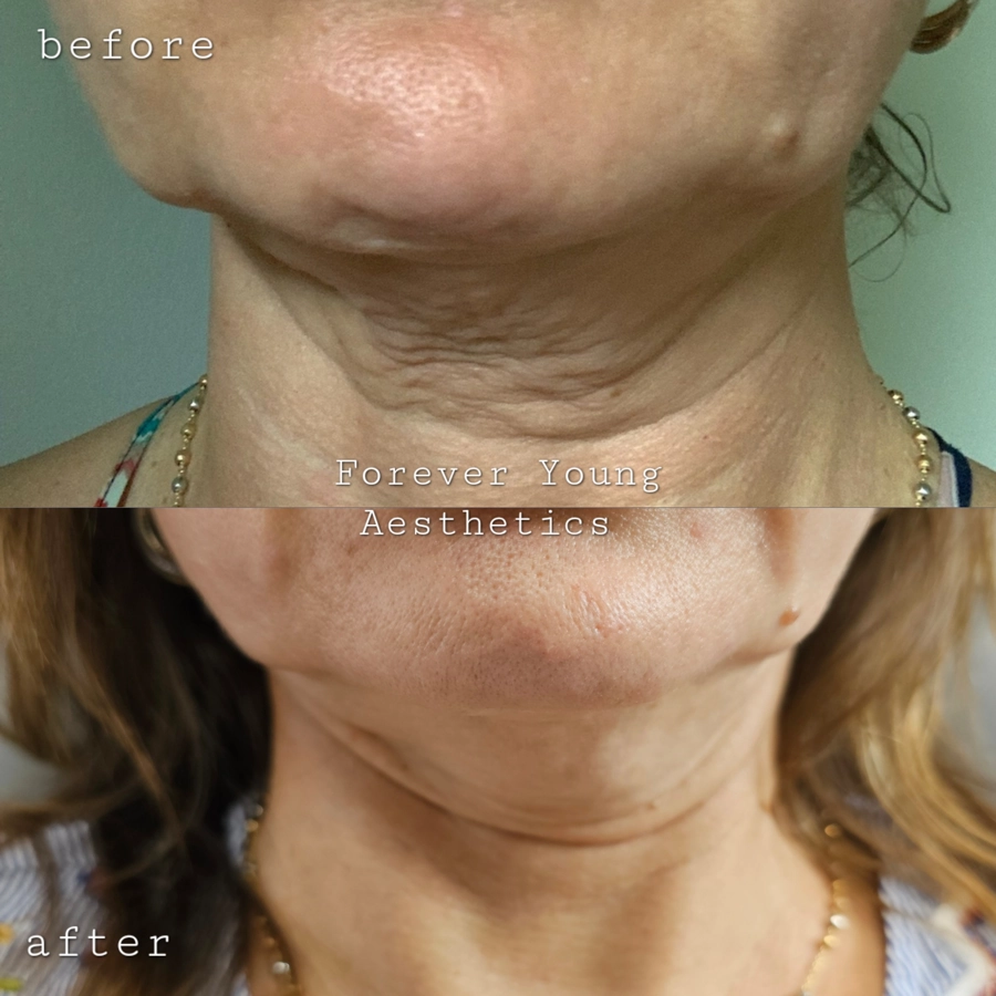 before & after 41