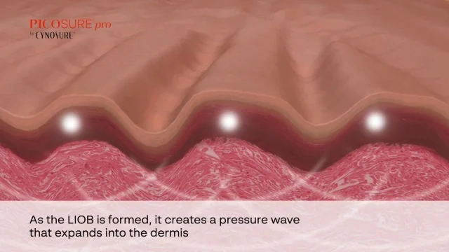 laser treatment