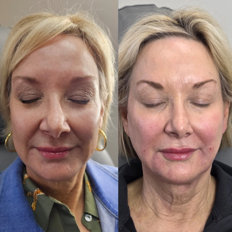 Before & After 13